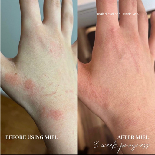 before and after of eczema hands